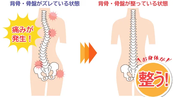 背骨・骨盤がズレいている状態と整っている状態